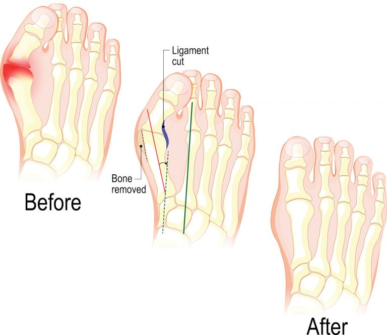 hallux-valgus-operatie